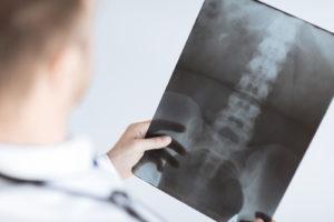 Common Spinal Injury Complications