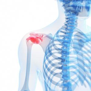 Rotator Cuff Injuries from a Car Accident