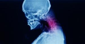 Radiculopathy from a Car Accident