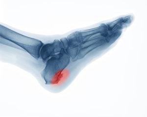 What is a bone spur from a car accident
