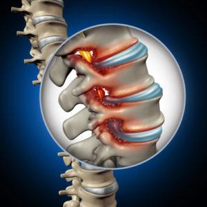 How do you get spinal stenosis from a car accident