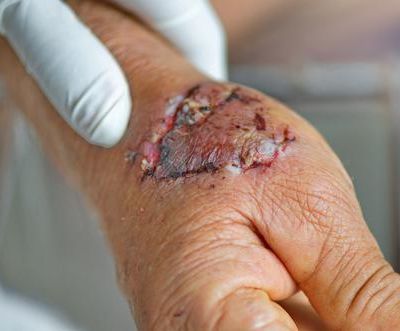 Three Severe Infections from Dog Bites