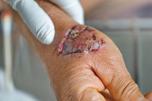 Three Severe Infections From Dog Bites | Bressman Law