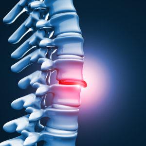 Hilliard Herniated Disc Lawyer