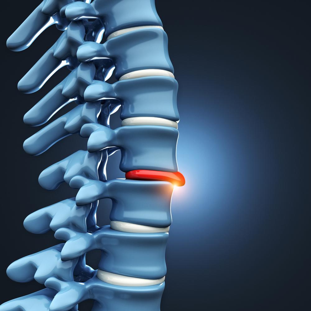 Dublin Herniated Disc Injury Lawyers Car Accidents Bressman Law