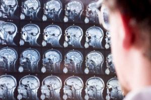 Is Traumatic Brain Injury Permanent?
