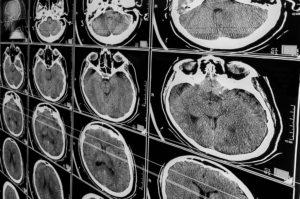 Gahanna Traumatic Brain Injury Lawyer